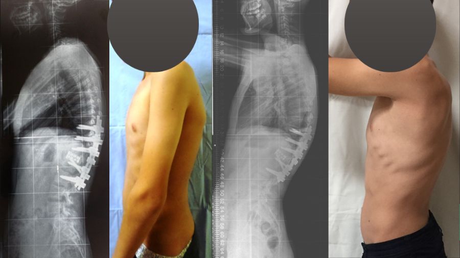 The artful dodger: capturing elusive spinal tuberculosis aka Potts disease