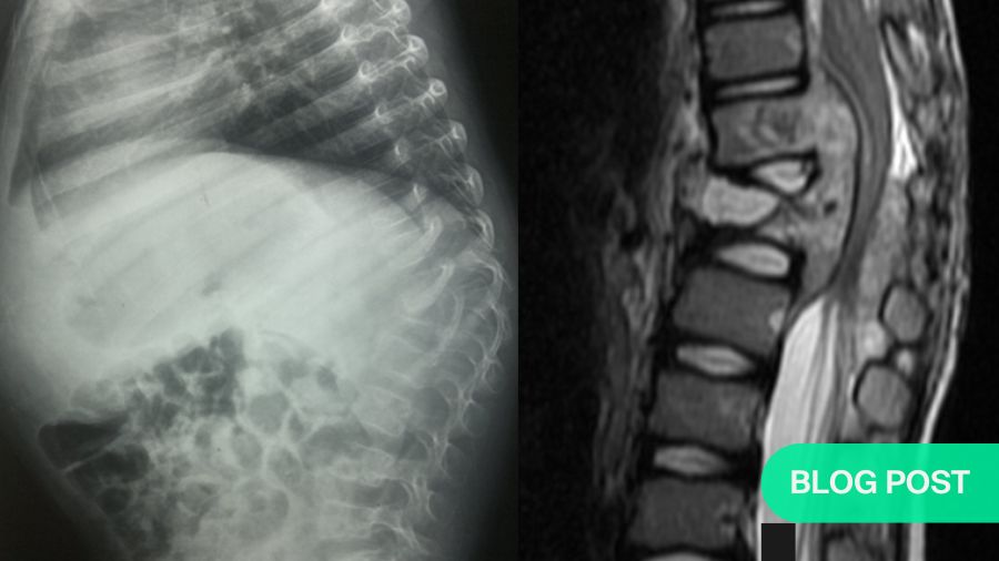 The artful dodger: capturing elusive spinal tuberculosis aka Potts disease