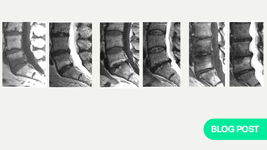 Modic changes: updated insights into back pain, MRI diagnosis, surgical outcomes, and emerging treatments