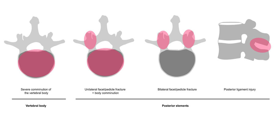 Figure 1. Schematic representation of the four basic patterns of unstable civilian thoracolumbar gunshot injuries. 