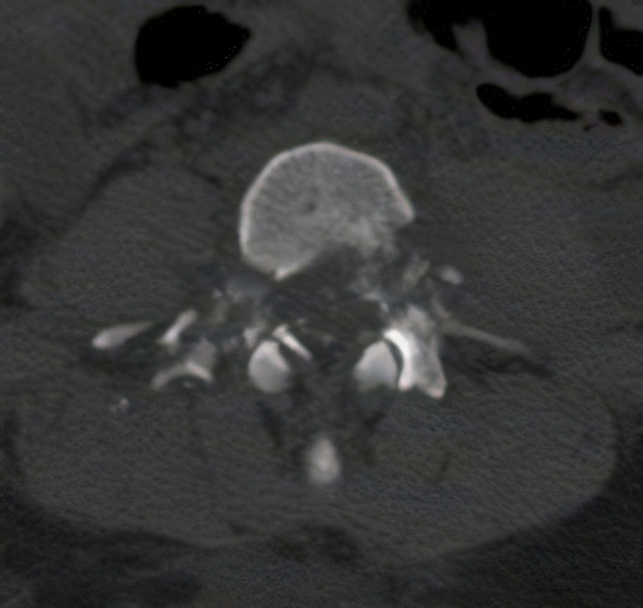 Figure 2. Axial CT scan showing bilateral lumbar pedicle fracture