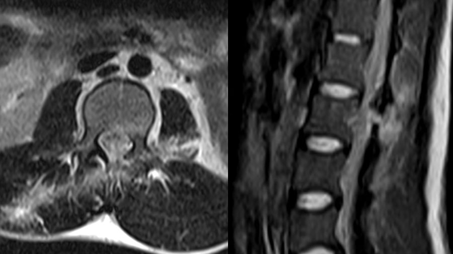 Figure 3. MRI showing injury to the posterior ligament complex