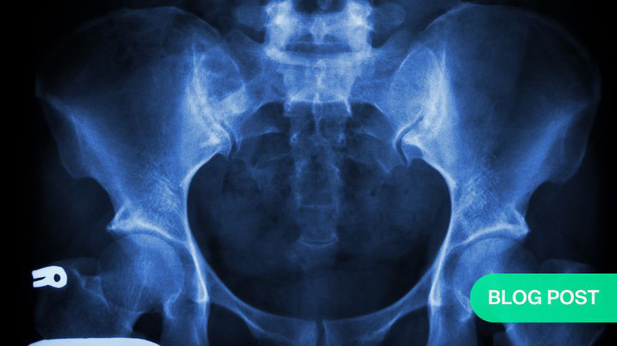 Sacral fractures: bridging spine and pelvic surgical expertise