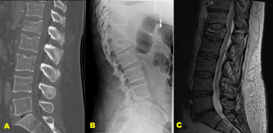 Lumar CT scan shows a compressive L1 fracture