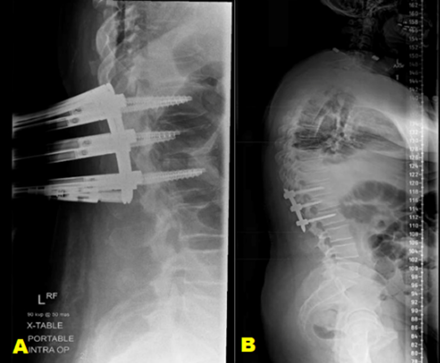 Percutaneous fixation with index level fixation