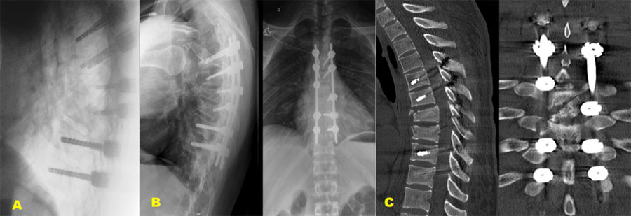 Long percutaneous T5-T10 pedicle fixation