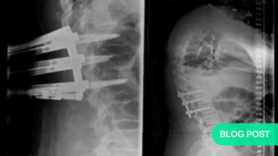 Minimally invasive surgery in thoracolumbar fractures: shifting towards targeted, muscle-sparing stabilization