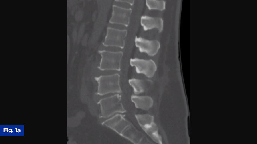 Case 1 Fig 1a: 56 yo M, hx of mild HTN