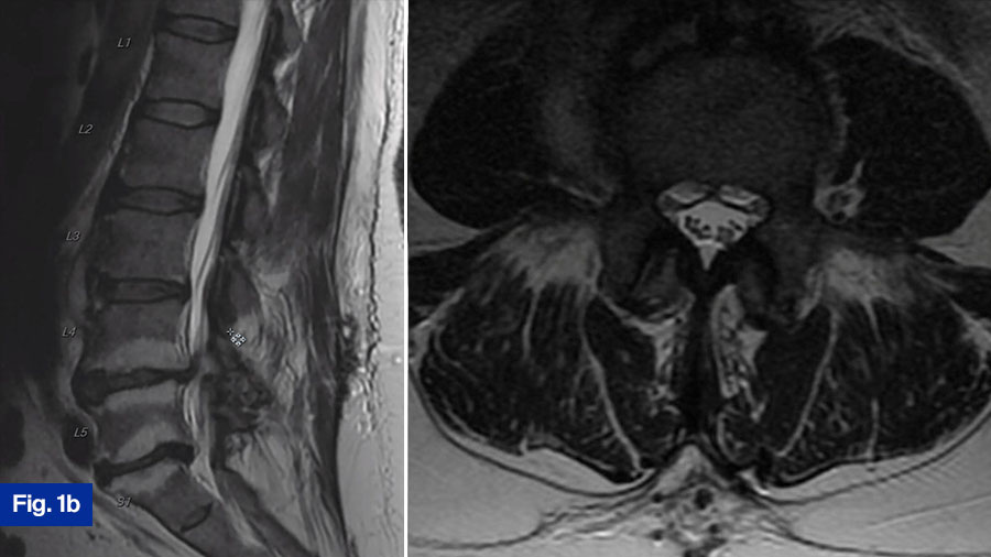 Case 1 Fig 1b: 56 yo M, hx of mild HTN