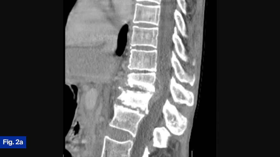 Case 2 Fig 2a: 57 yo M, polysubstance use (IVDU)