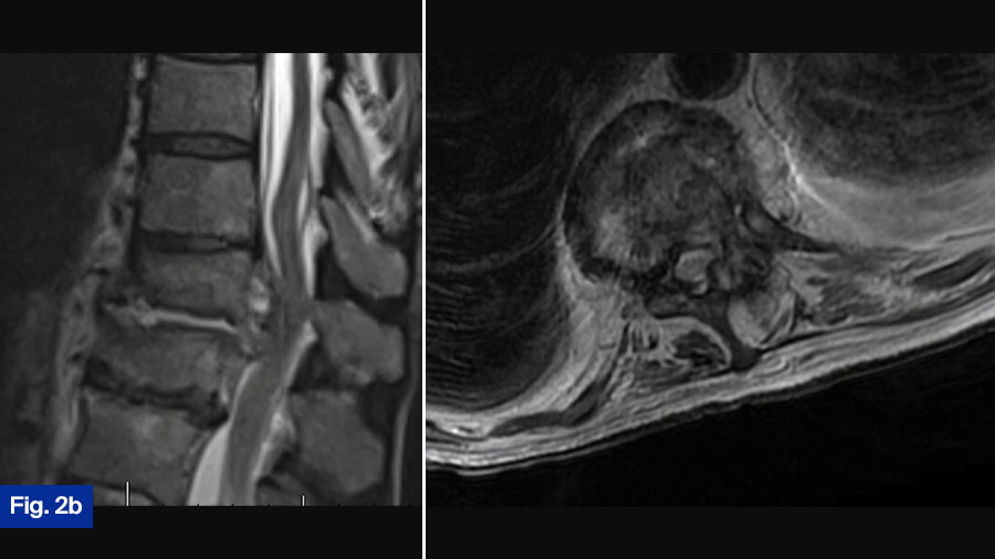 Case 2 Fig 2b: 57 yo M, polysubstance use (IVDU)