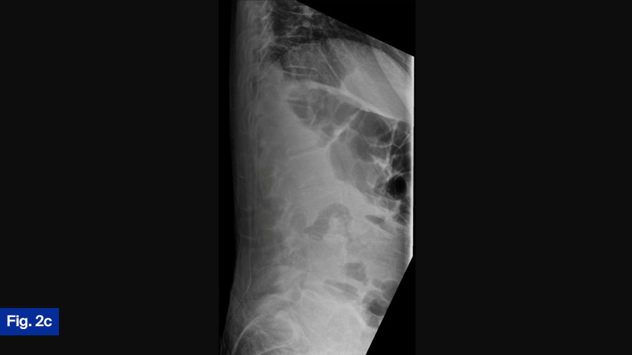 Case 2 Fig 2c: 57 yo M, polysubstance use (IVDU)