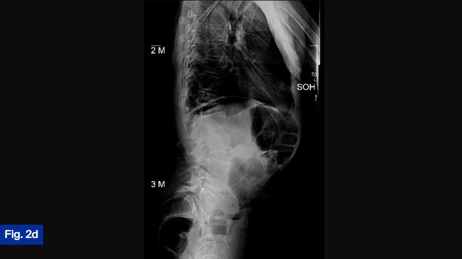 Case 2 Fig 2d: follow-up for 57 yo M, polysubstance use (IVDU)