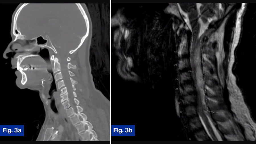 Case 3 Figs 3a and 3b: 63 yo M, hx of HLD, HTN