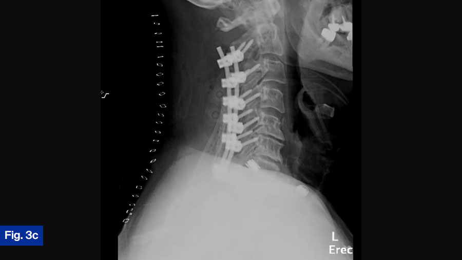 Case 3 Fig 3c: 63 yo M, hx of HLD, HTN, follow-up