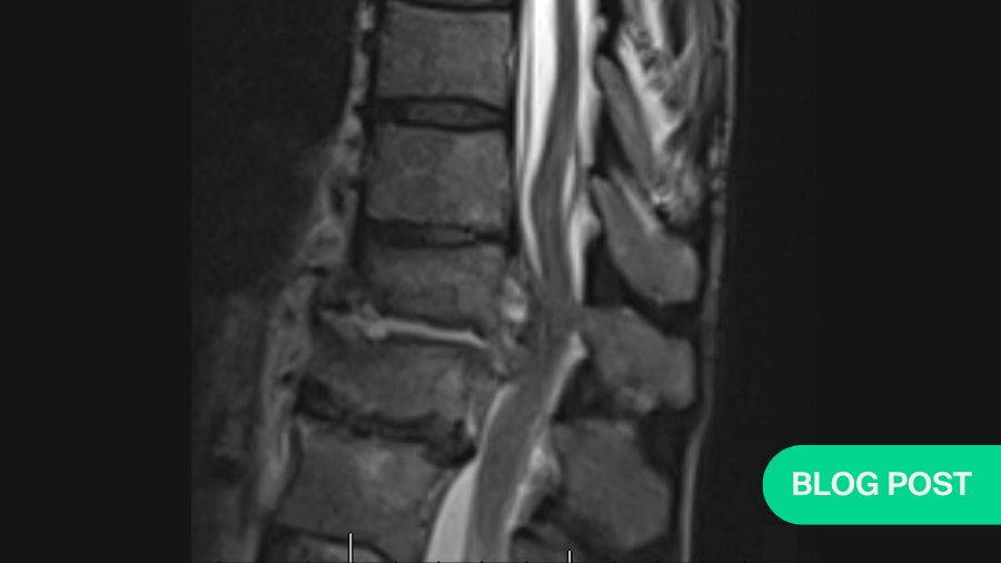 Controversies in treating complex spinal infections: case studies and expert insights