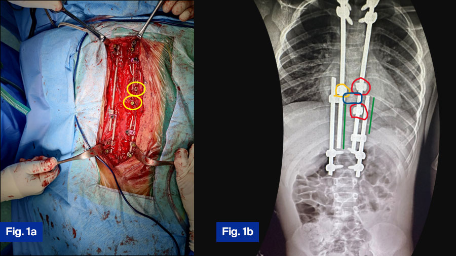 Fig 1a Intra-operative implant construct, Fig 1b Radiographic images of APC surgery