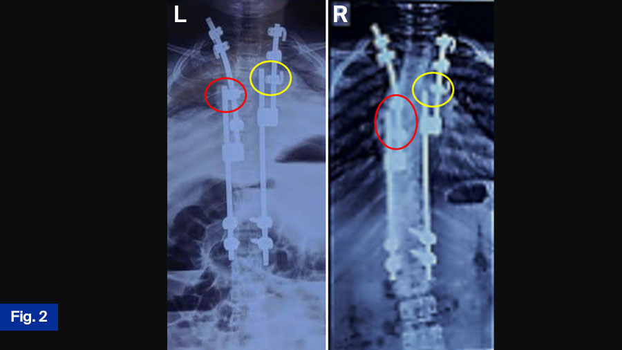 Fig 2 Comparison of Radiographic images, post-operative and 1-year follow-up