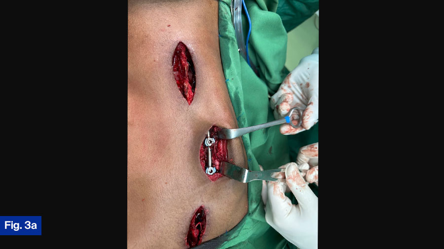 Less invasive technique with limited incisions