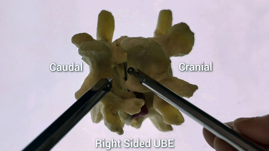 Caudal, Cranial, Right-sided UBE