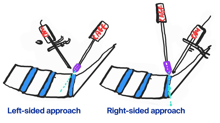 Left-sided approach v right-sided approach 1