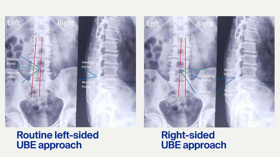 Left-sided approach v right-sided approach 2 (x-rays)