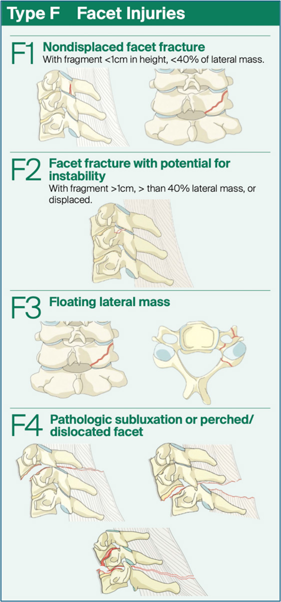 Cervical Subaxial Facet Injuries