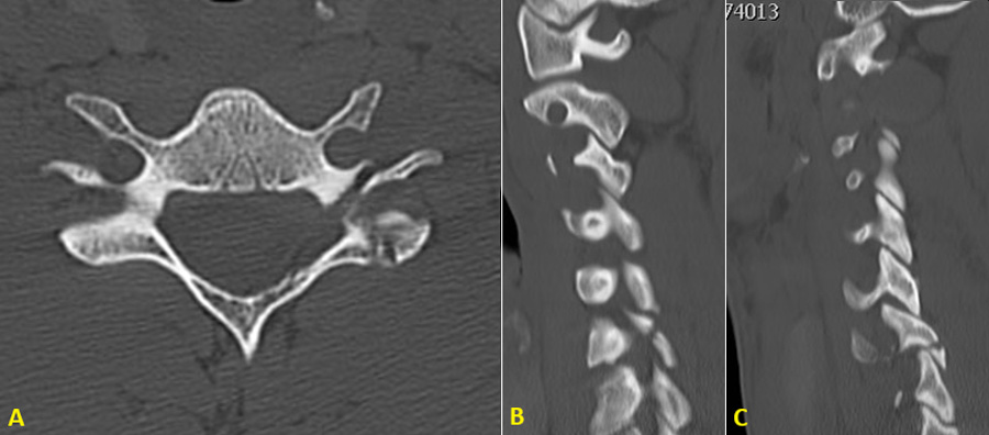 Cervical Subaxial Facet Injuries