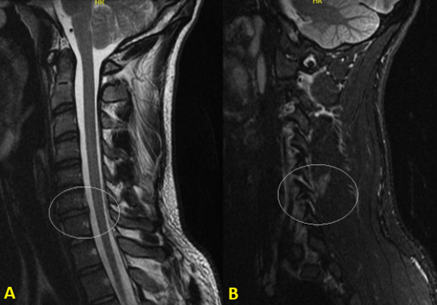 Cervical Subaxial Facet Injuries