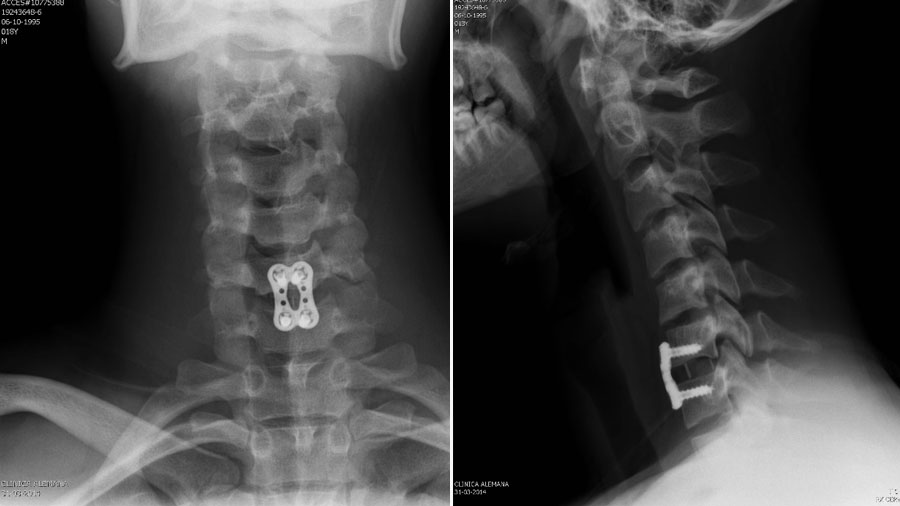 Cervical Subaxial Facet Injuries