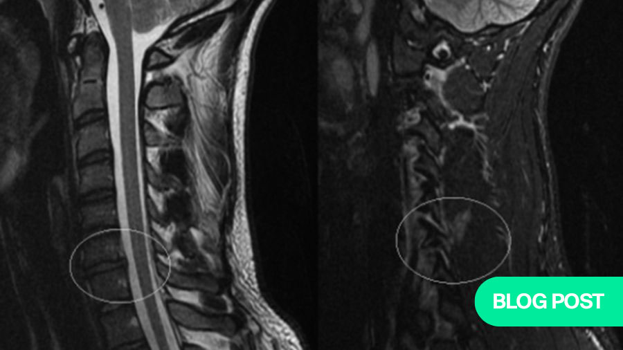 Cervical Subaxial Facet Injuries: evaluation, management, and how to use the AO Spine Classification System