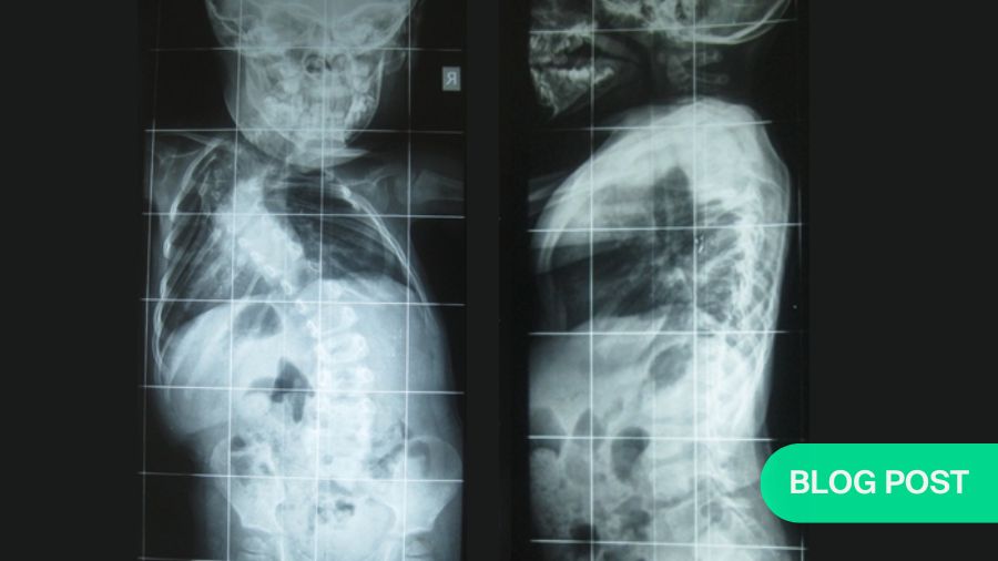 A game of chess: surgical strategies for the treatment of congenital scoliosis