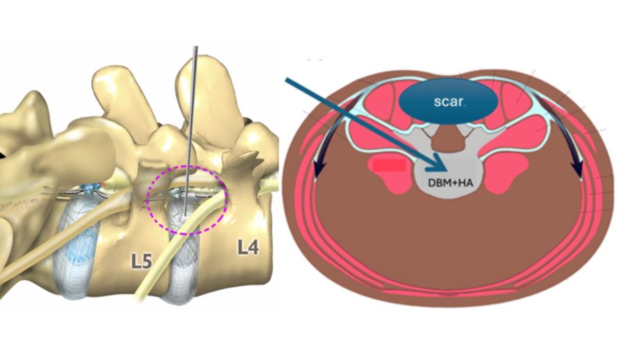 anatomic schematics of Kambin’s triangle and axial view of the lumbar spine showing the usual postero-lateral trajectory of a trans-Kambin approach