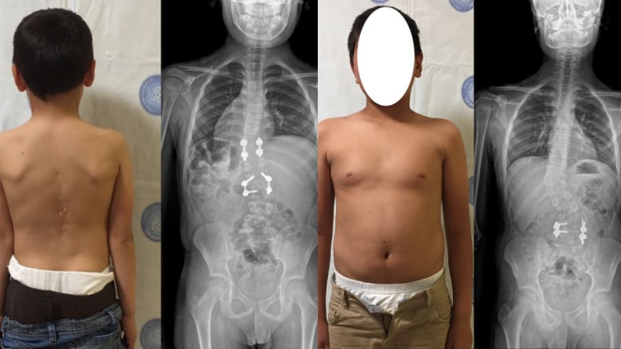 Two siblings with congenital scoliosis