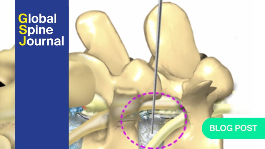Anatomic schematics of Kambin’s triangle that allows an extra-foraminal approach to the disk and canal bypassing the exiting nerve root