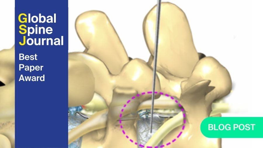 How good is trans-Kambin TLIF with a large-footprint interbody compared to ALIF?