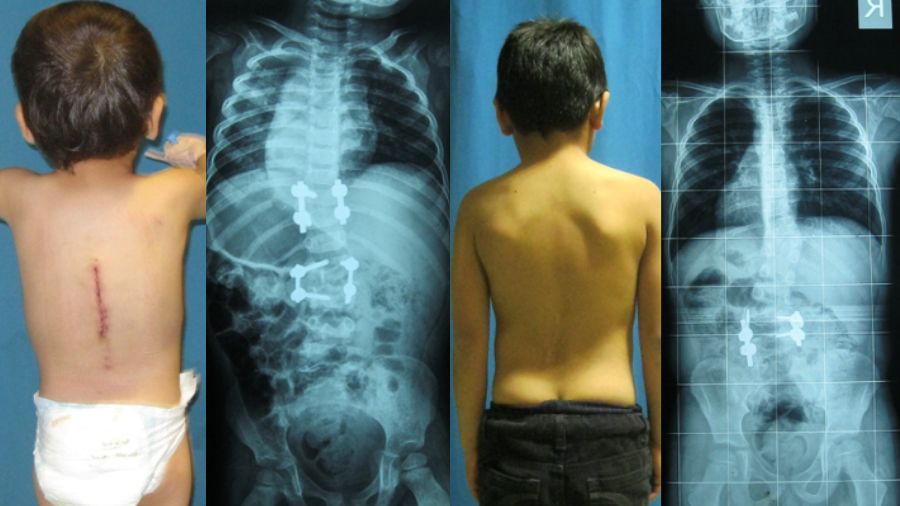 Multiple congenital deformities requiring early surgical intervention and a growth rod to stabilize severe curvature of the spine
