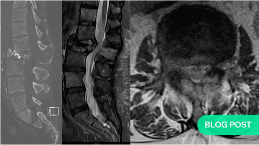 How to apply molecular prognostication in spine oncology in clinical practice