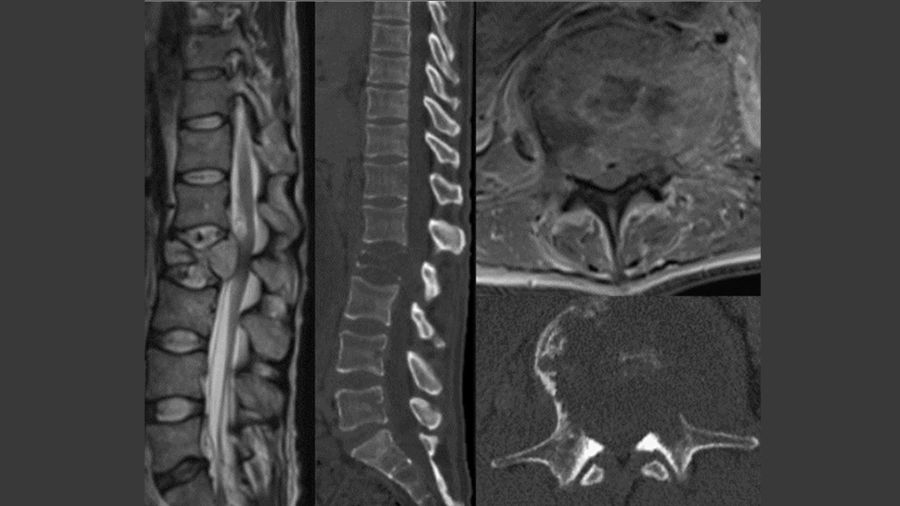 Sagittal and axial CT and MRI demonstrating a lytic L2 lesion causing a pathologic fracture with greater than 50% loss of height, retropulsion, and epidural compression.