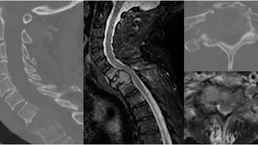 Sagittal and axial CT and MRI demonstrating lytic T1 pathologic fracture with epidural extension.