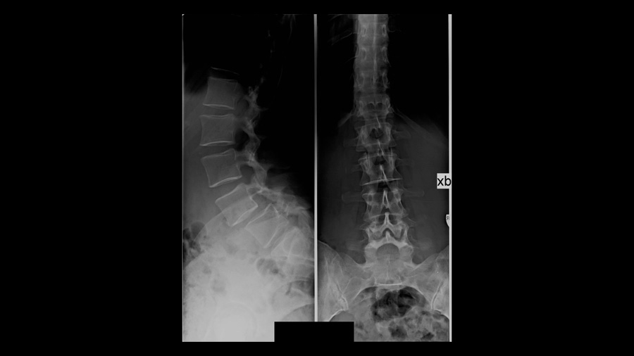 Optimizing lower lumbar lordosis and pelvic tilt in high pelvic incidence