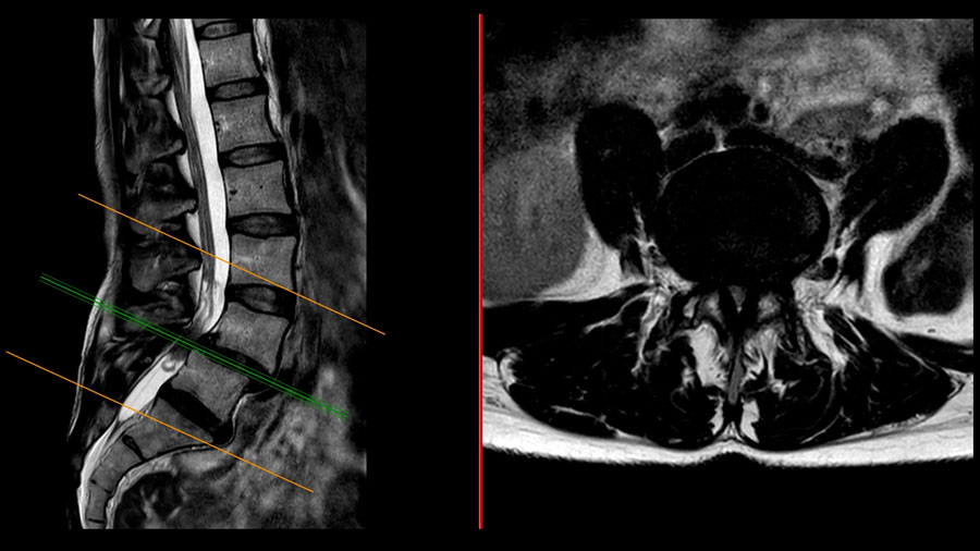 Optimizing lower lumbar lordosis and pelvic tilt in high pelvic incidence