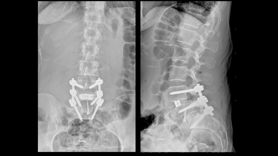 Optimizing lower lumbar lordosis and pelvic tilt in high pelvic incidence