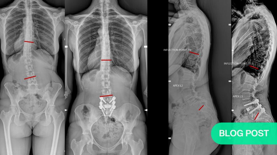 Optimizing lower lumbar lordosis and pelvic tilt in high pelvic incidence