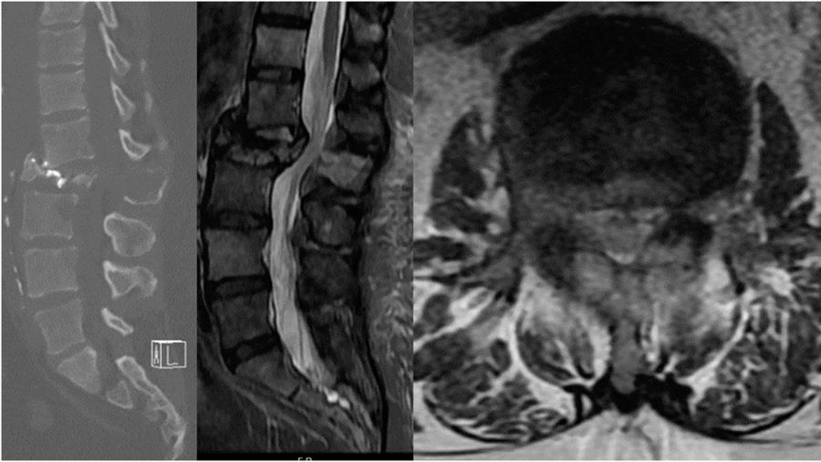 Sagittal CT and MRI and axial MRI demonstrating at L2 causing a pathologic fracture with greater than 50% loss of height and retropulsion, bony destruction of posterior elements, and epidural compression.