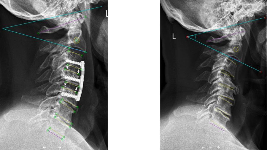 Cervical sagittal alignment: why ACDF should be planned as a global intervention