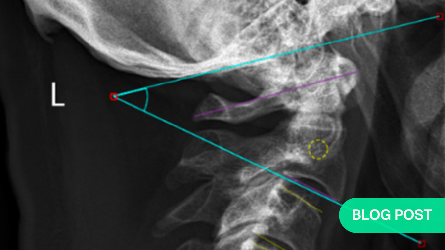 Cervical sagittal alignment: why ACDF should be planned as a regional intervention