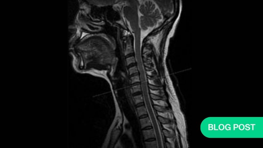 Motion-preserving surgery for degenerative cervical myelopathy: balancing innovation with evidence based practice