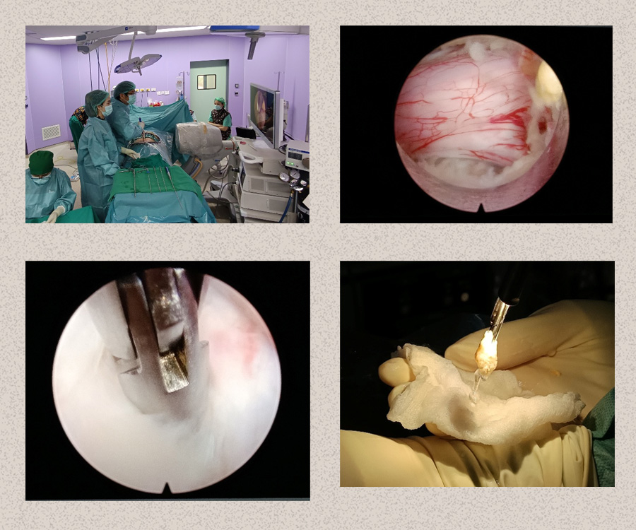10 essentials to know before starting lumbar endoscopic spine surgery