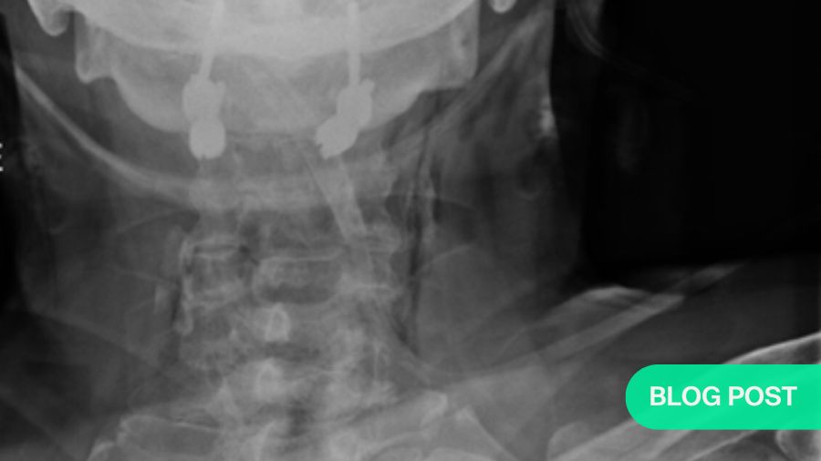 Atlantoaxial instability—decision options in the modern era